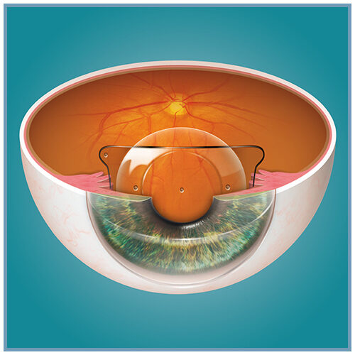 implant ICL STAAR SURGICAL