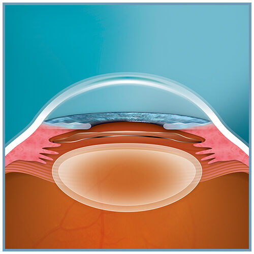 implant ICL STAAR SURGICAL