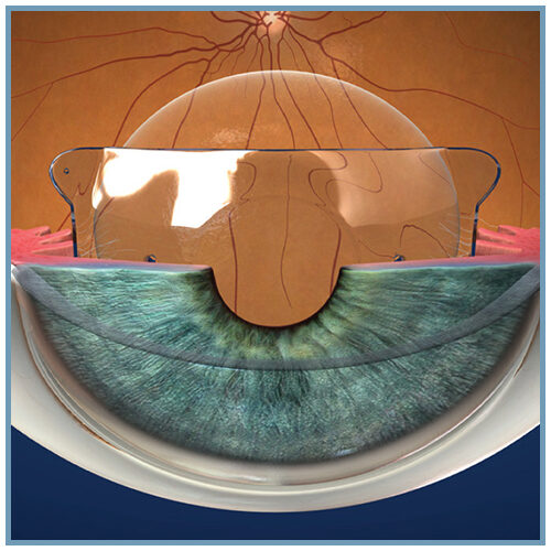 implant ICL STAAR SURGICAL